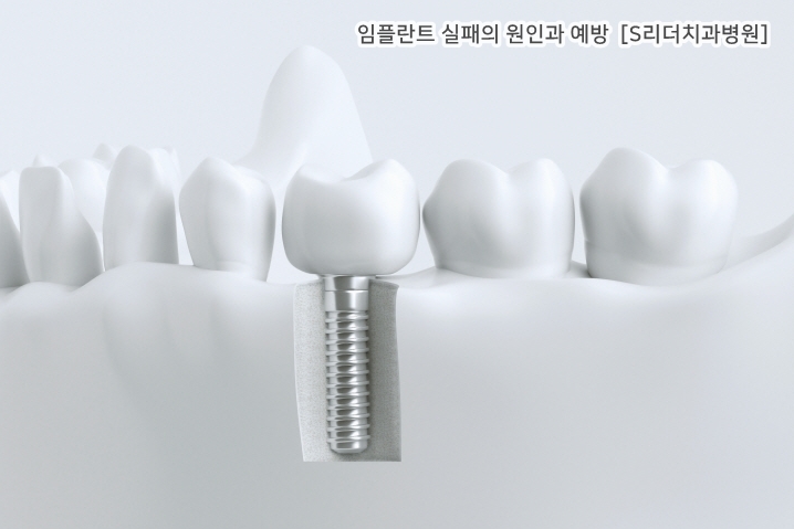 임플란트실패의 원인과 실패를 예방하는 방법은? 관련 이미지 3
