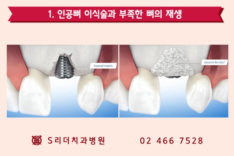 건대치과 성공적인 임플란트를 위한 포인트! 관련 이미지 4