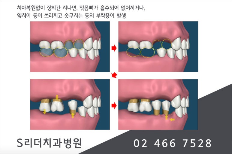 건대임플란트가 궁금해~ 관련 이미지 4