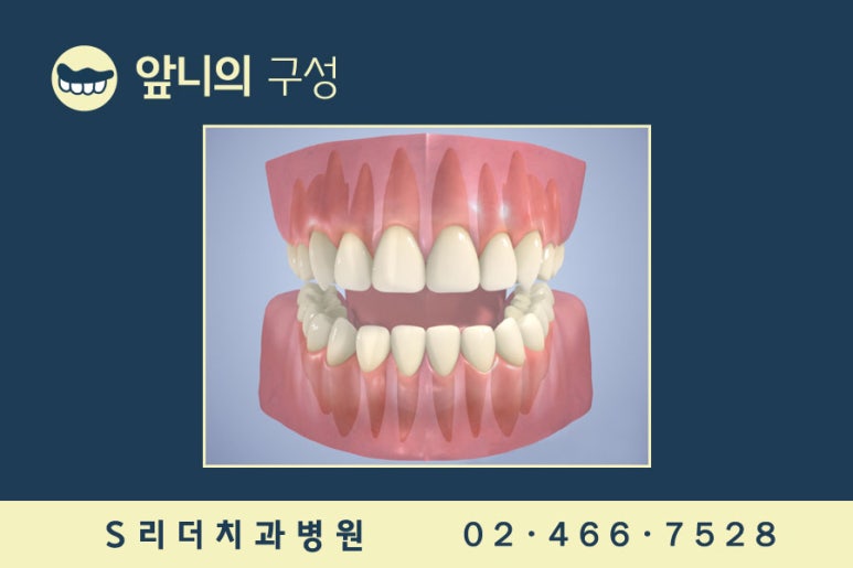 앞니임플란트 2개로 6개치아 완성 관련 이미지 4