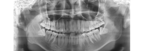 A Complete Guide to Wisdom Tooth Extraction Criteria at Muk-dong Dental Clinic | Cases That Must Be Removed vs. Cases That Can Be Kept image 7