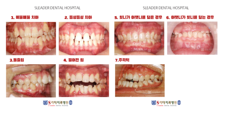 용마산역치과, 덧니 주걱턱 치아교정 개선하기 위한 과정은 관련 이미지 8