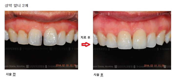 Seoul Yangsim Dental Clinic Laminate &middot; Orthodontic Treatment: Which Procedure Is Right for Me? image 4