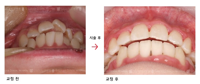 [사가정역치과] 돌출입 교정, 유형별로 치료방법 다르게 적용해야 관련 이미지 4