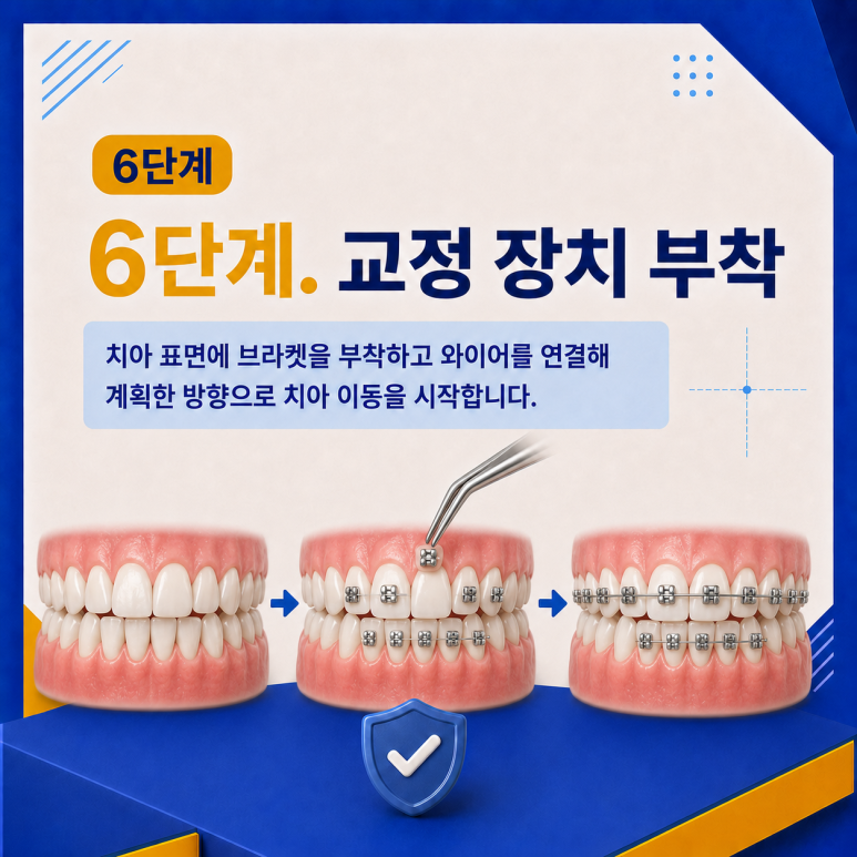 군자역치과 치아교정은 어떤 순서로 진행될까요? 단계별 과정 정리 관련 이미지 7