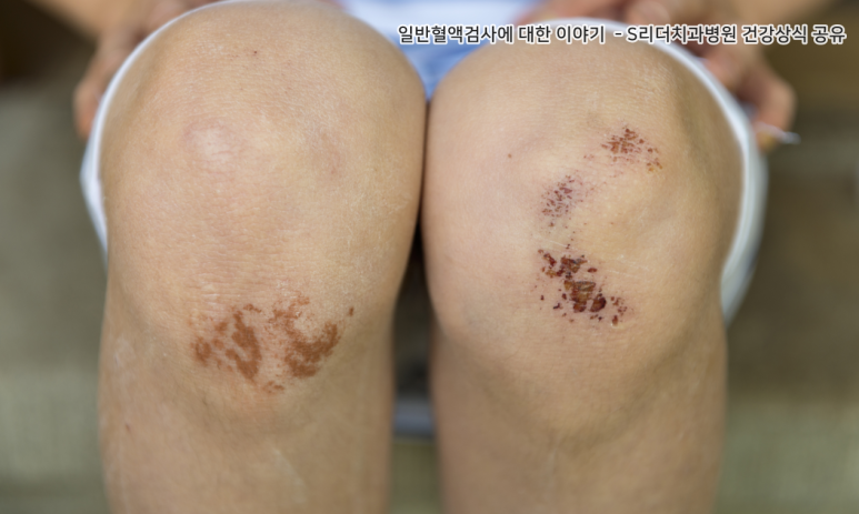 일반혈액검사를 하는 이유와 알수있는 질병은 무엇일까? 관련 이미지 6