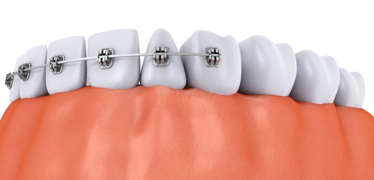 The Golden Time for Adolescent Orthodontic Treatment: Criteria Explained by a Seoul Orthodontic Dental Clinic Recommendation image 4