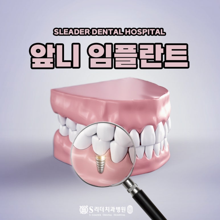Seongdong-gu Dental Clinic: What Should Be Considered for Front Tooth Implants? image 1