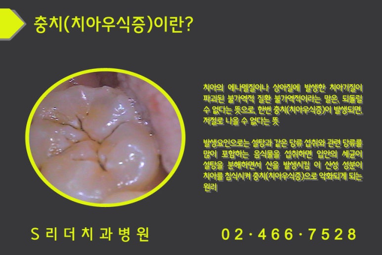 충치(치아우식증)예방 자양동치과,화양동치과 관련 이미지 3