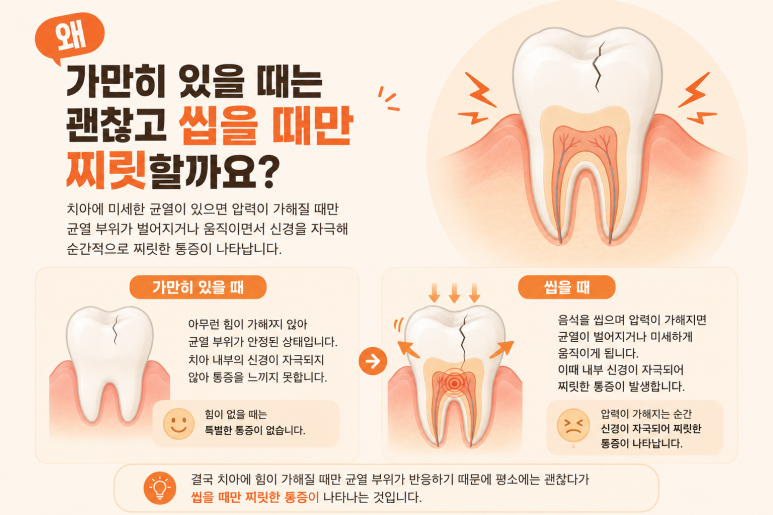 송정동치과, 씹을 때만 치아가 찌릿하다면 치아 균열 때문일까요? 관련 이미지 4