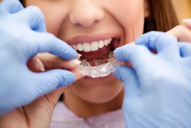 Konkuk University Orthodontic Clinic: Why Do Celebrities Prefer Clear Aligners for Orthodontic Treatment? image 3