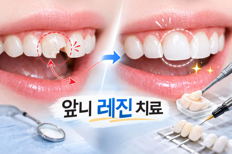 Guwi Station Dental Clinic｜Front Tooth Fracture Treatment Criteria: Resin vs. Laminate vs. Crown image 4