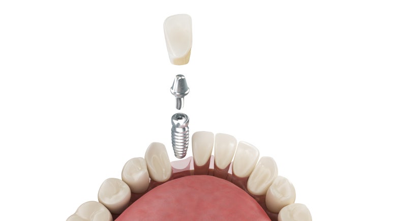 Junggangu Implant, Why Do Implants for Older Adults Require a More Careful Choice? image 5