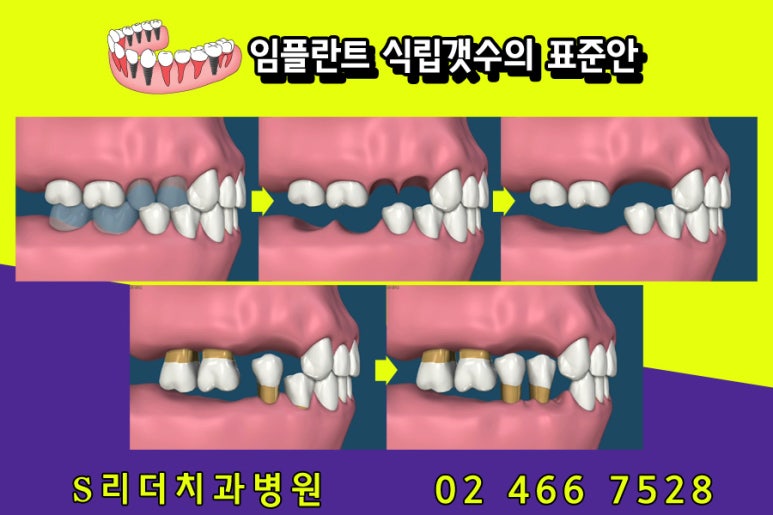 건대임플란트 치료양은 적게 하면서 효과는 높게 도출... 관련 이미지 3