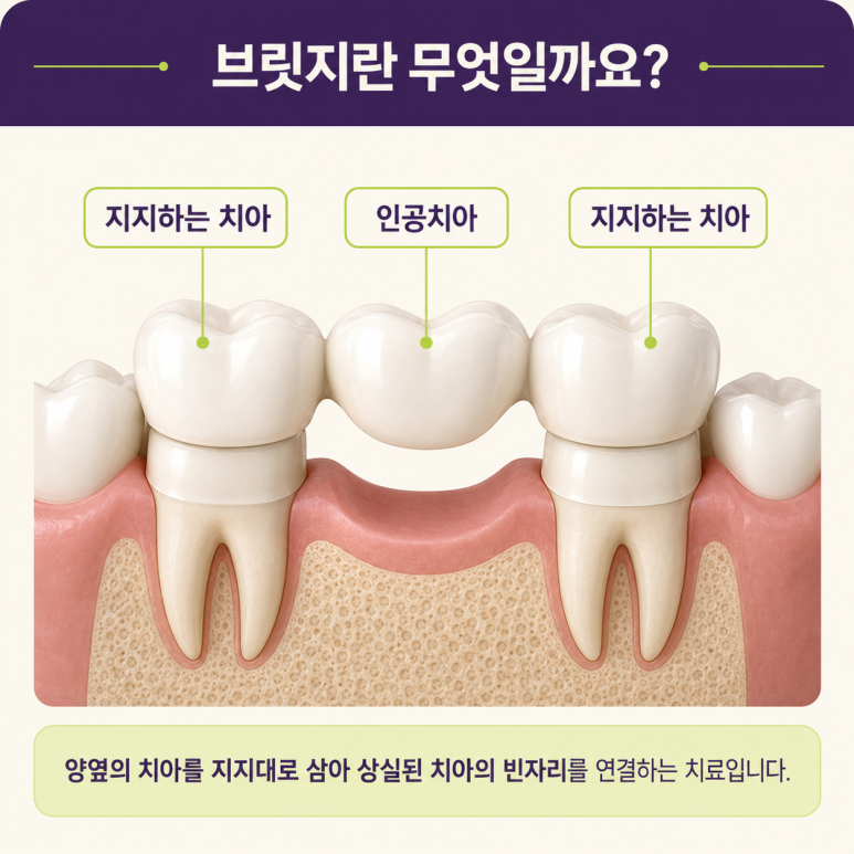 성수동임플란트, 치아 상실 후 임플란트·브릿지·틀니 어떤 차이가 있을까? 관련 이미지 5