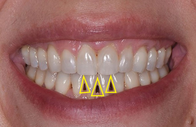 Seoul Yangsim Dental Clinic｜Why Black Triangles Form and How to Fix Them image 3