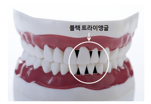면목역치과, 웃을 때 보이는 삼각형 틈? 블랙트라이앵글 원인부터 해결까지 관련 이미지 2