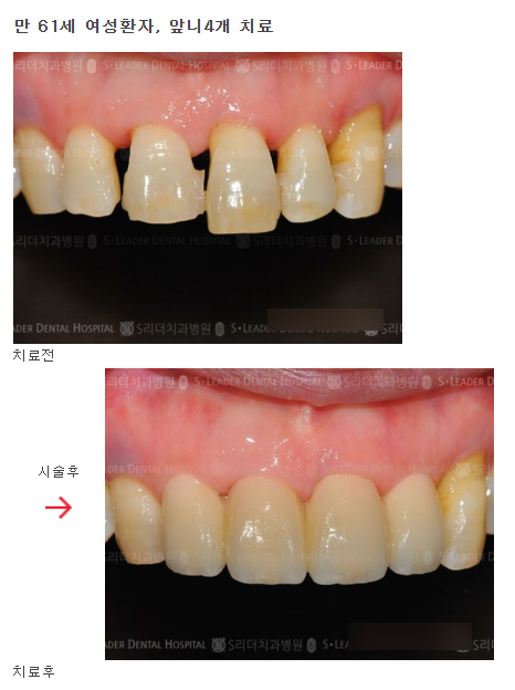 Sanggye-dong Dental Clinic, What Is the Difference Between Laminate and All-Ceramic? image 5
