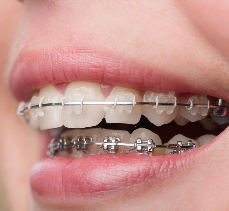 Ttukseom Station Dental Clinic: Is Orthodontic Treatment in Your 30s & 40s Too Late? 5 Things to Know Before Starting Adult Orthodontic Treatment image 7