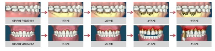 Dongdaemun-gu Dental Clinic｜Is Scaling Enough? A Complete Guide to Why Gum Treatment May Also Be Needed image 4