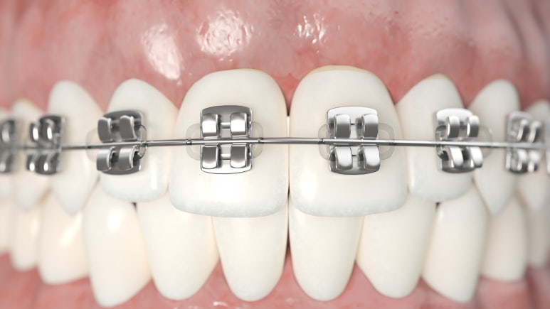 Guwi Station Dental Clinic: After Orthodontics, How Long Should You Wear a Retainer? image 2