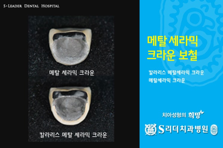 건대치과 치아성형 잘하는 곳 궁금해? 관련 이미지 10