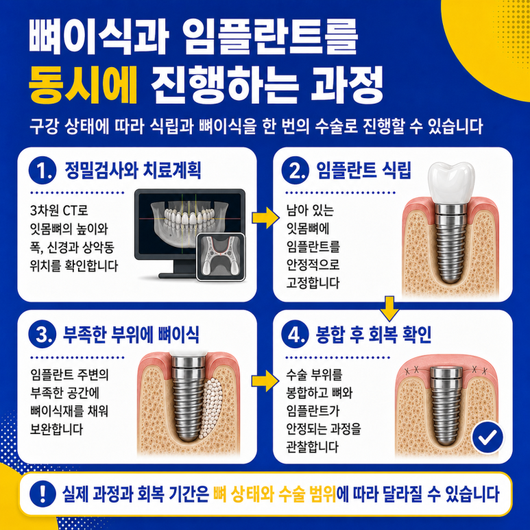 Hwanyang-dong Dental Clinic: Can Bone Grafting and Implant Placement Be Performed at the Same Time? image 7