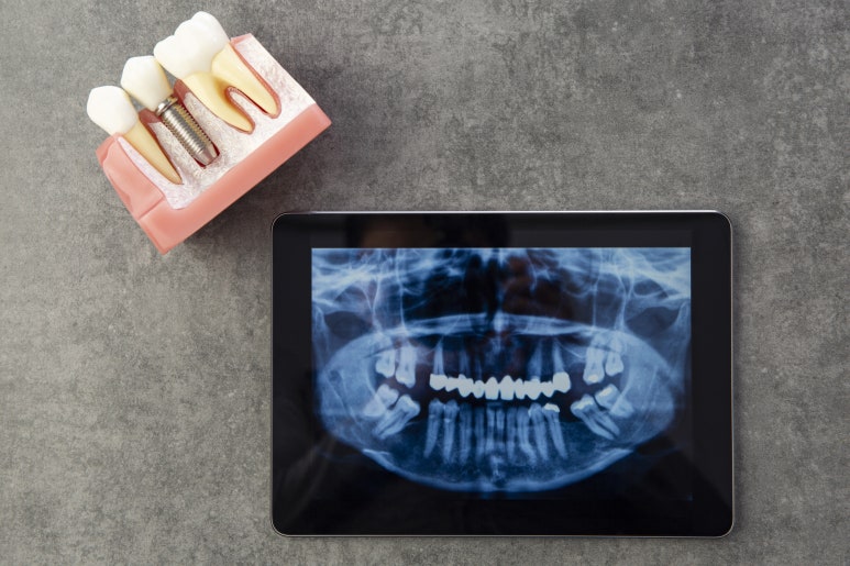 [Jayang Station Implant] Full-Mouth Implants, Including Systematic Aftercare image 6