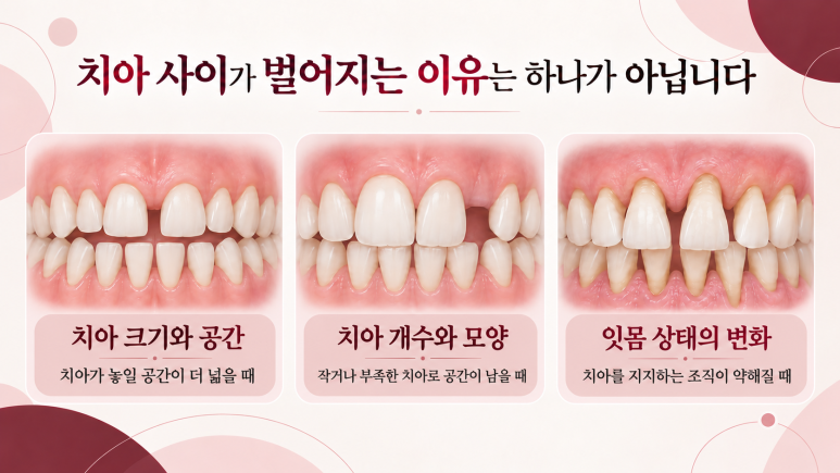 건대역치아교정, 치아 사이가 벌어졌다면 교정으로 해결할 수 있을까요? 관련 이미지 2