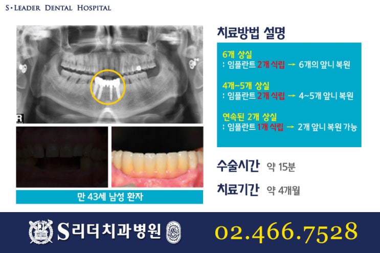 앞니임플란트 몇개를심어요? 관련 이미지 5
