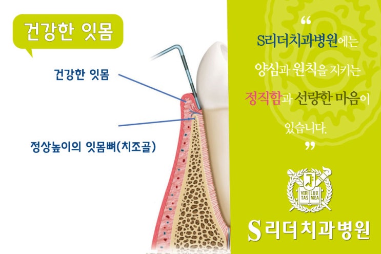 건대치과 치주과 칼럼 : 잇몸약, 제대로 알고 드십니까? 관련 이미지 4