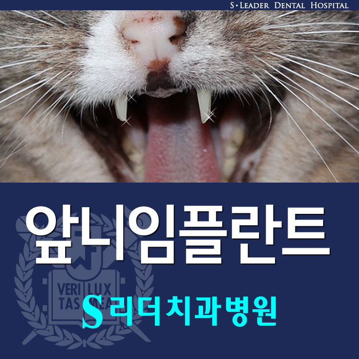 앞니임플란트 몇개를심어요? 관련 이미지 1