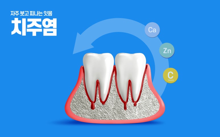 Nungdong Dental Clinic: The Real Reasons Periodontitis Is Progressing Faster in People in Their 20s and 30s, and How to Manage It image 9