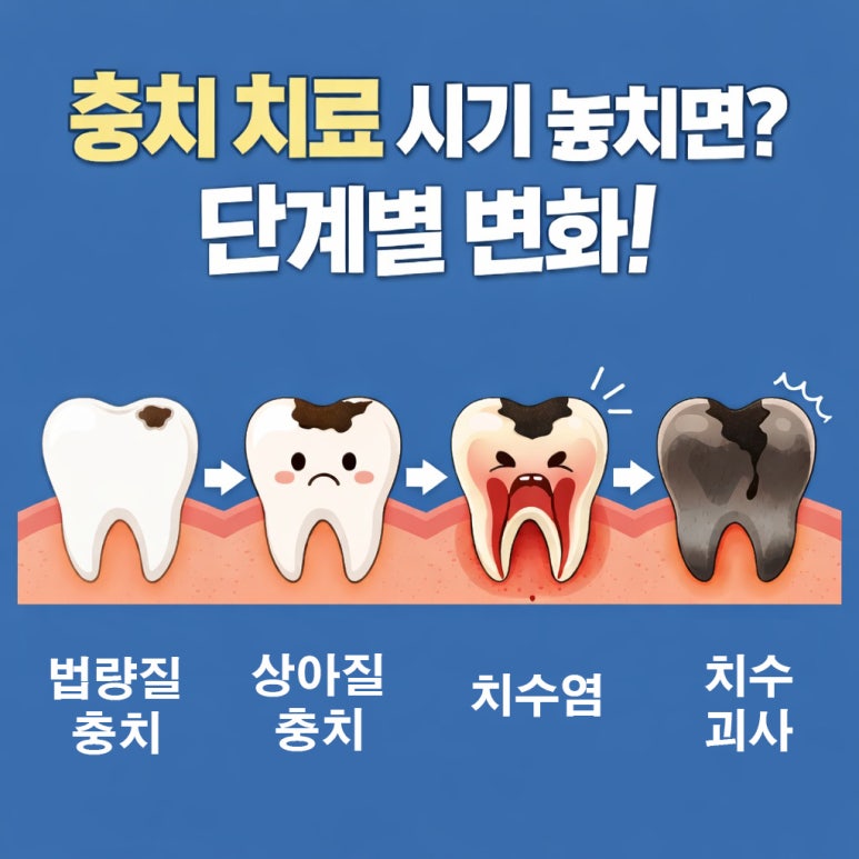 Gwangjin-gu Dental Clinic: Missing the Timing for Cavity Treatment Can Be Serious | Check the Changes by Stage image 1