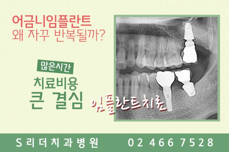 어금니임플란트 왜자꾸반복될까? 관련 이미지 2