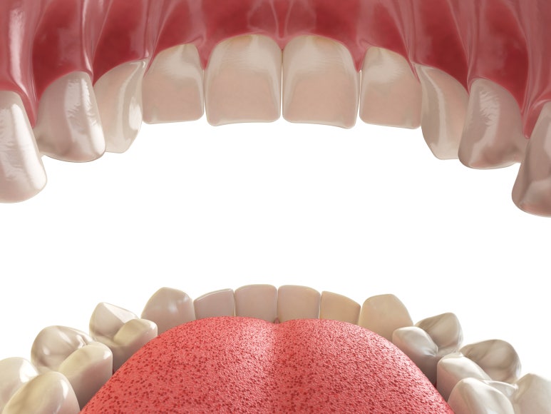 Seongdong-gu Dental Clinic: What Should Be Considered for Front Tooth Implants? image 2