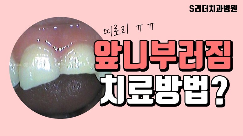 성동구치과 앞니 끝 깨짐 치료, 당일 레진 복원 가능성은? 관련 이미지 5