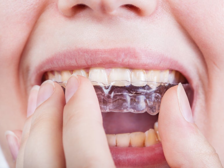 [Guwi Station Dental Clinic] Can Partial Orthodontic Treatment for Canine Teeth Be Done in 6 Months? image 3