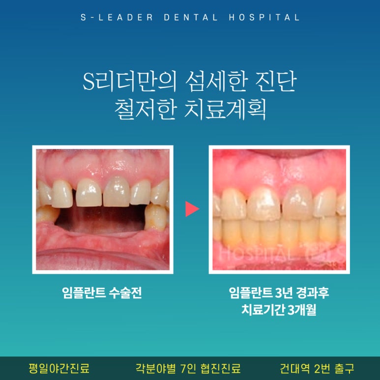[Sagajeong Station Dental Clinic] Implant Prosthetic Peri-implantitis: How Can It Be Prevented? image 6