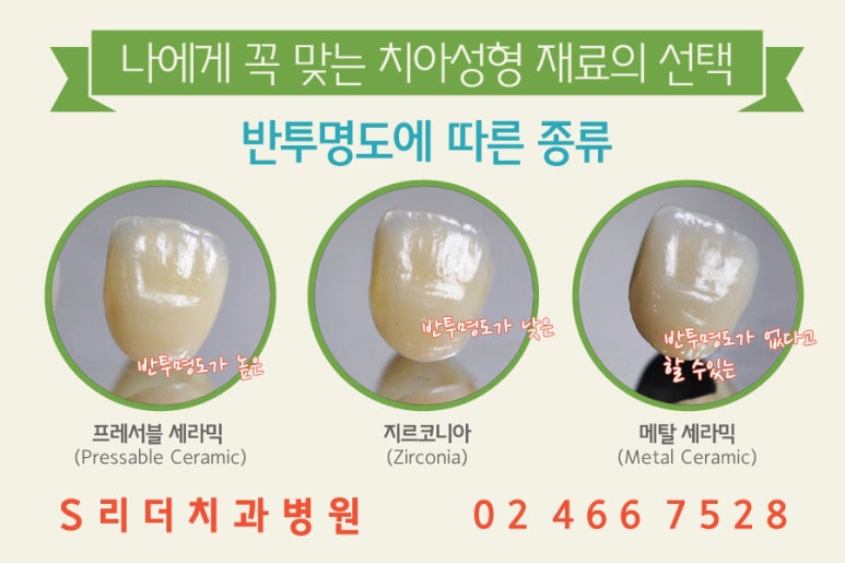 앞니치아성형 내마음에 쏙~들려면 관련 이미지 4