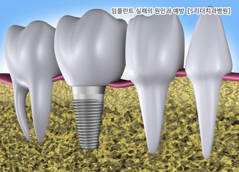 임플란트실패의 원인과 실패를 예방하는 방법은? 관련 이미지 2