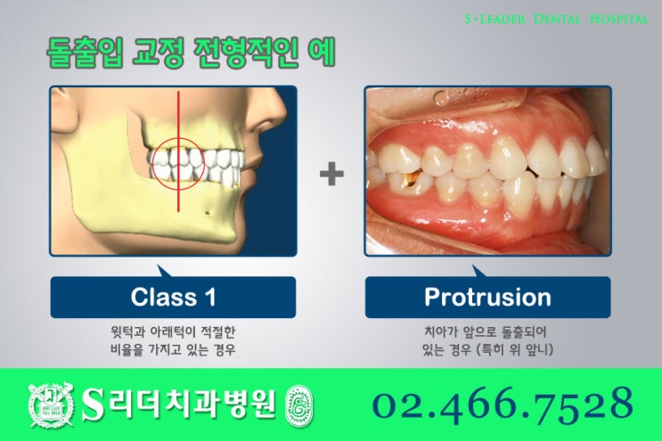 건대교정치과 똑같은 돌출입치아교정이 아니라는 점. 관련 이미지 2