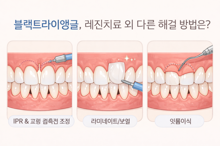동대문구치과|교정 후 블랙트라이앵글, 왜 생길까? 레진으로 메울 수 있을까 관련 이미지 7