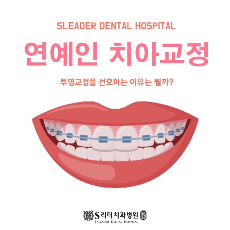 Konkuk University Orthodontic Clinic: Why Do Celebrities Prefer Clear Aligners for Orthodontic Treatment? image 1