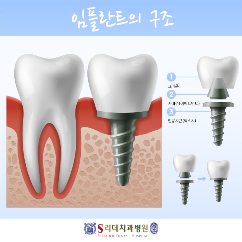 상봉동임플란트, 결과는 진단에서 결정됩니다. 관련 이미지 2