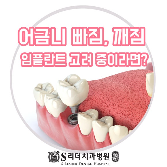 어금니깨짐 부러짐 깊은 파절 방치하지 말고 관련 이미지 4