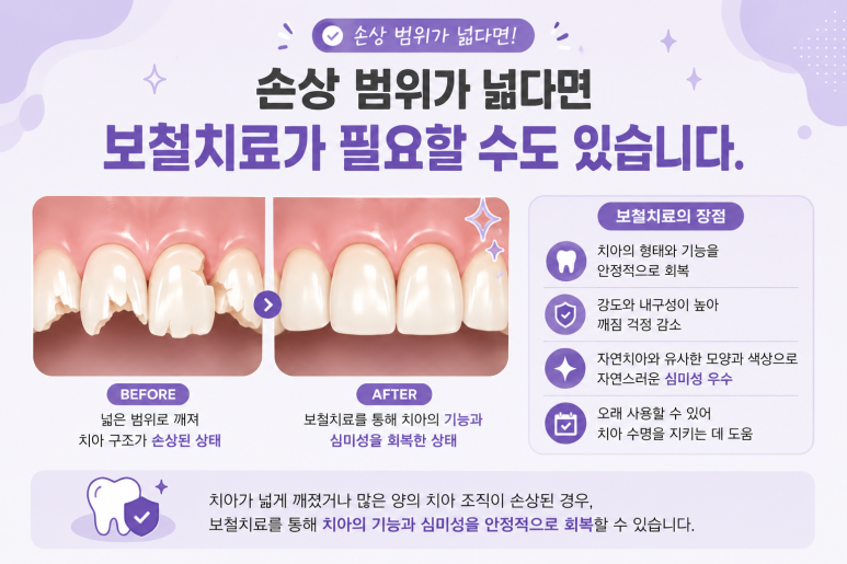 군자동치과 앞니 여러 개가 동시에 깨졌다면? 치아마다 치료 방법이 다른 이유 관련 이미지 5