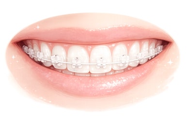 Gwangjin-gu Dental Clinic Orthodontics: How Should I Choose the Right Method for Me? image 5