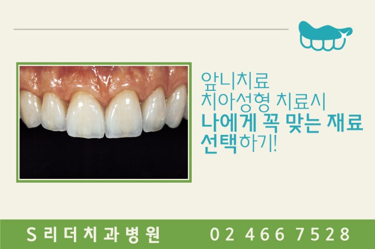 앞니치아성형 내마음에 쏙~들려면 관련 이미지 9