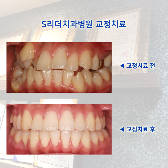 군자동치과 추천｜발치교정 vs 비발치교정 차이와 선택 기준 정리 관련 이미지 6